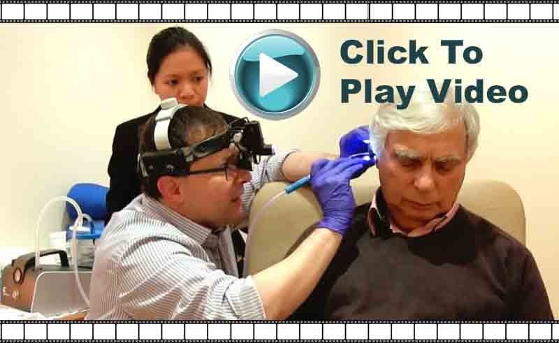 video of microsuction ear wax removal havant
