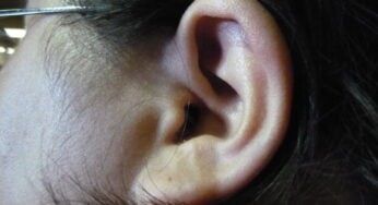 Weighing the Risks: Who Should Avoid Microsuction for Ear Wax Removal